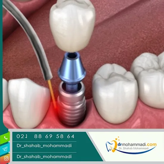 کاربرد لیزر در جراحی ایمپلنت